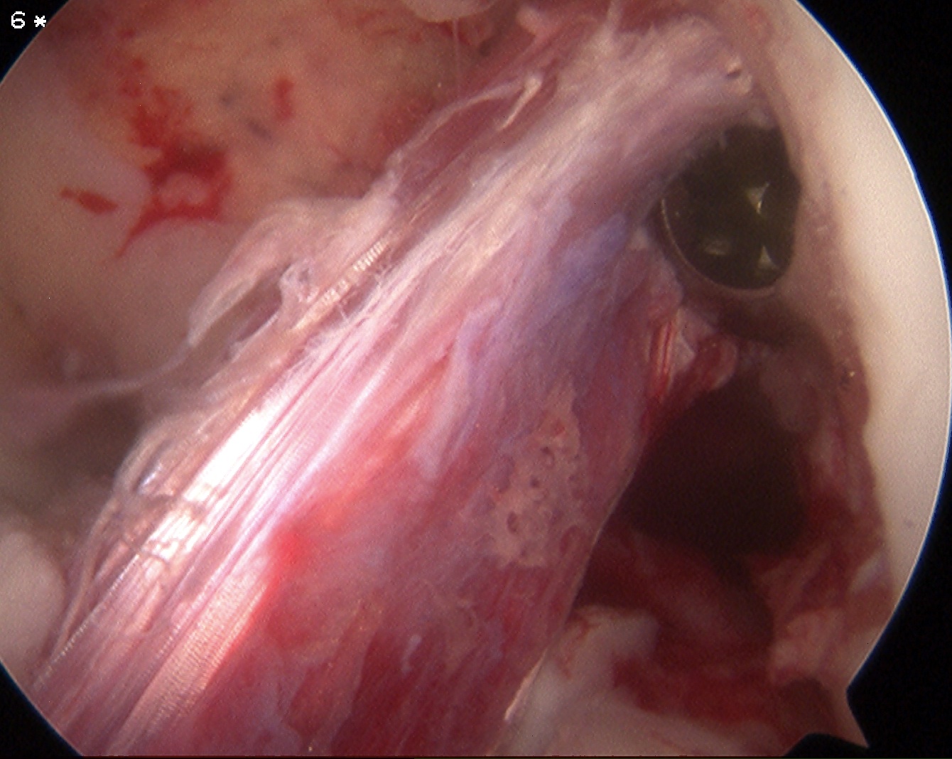 ACL BPTB in situ